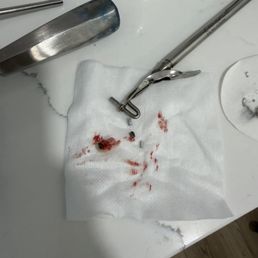 That's the tooth removed That's the tooth removed
