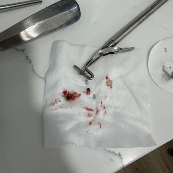 Western Dental & Orthodontics - That's the tooth removed - Orthodontists Near Me - Carson, California Western Dental & Orthodontics - That's the tooth removed - Orthodontists Near Me - Carson, California