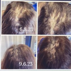 Hair Growth Clinic - After hair loss from hair extensions!!!