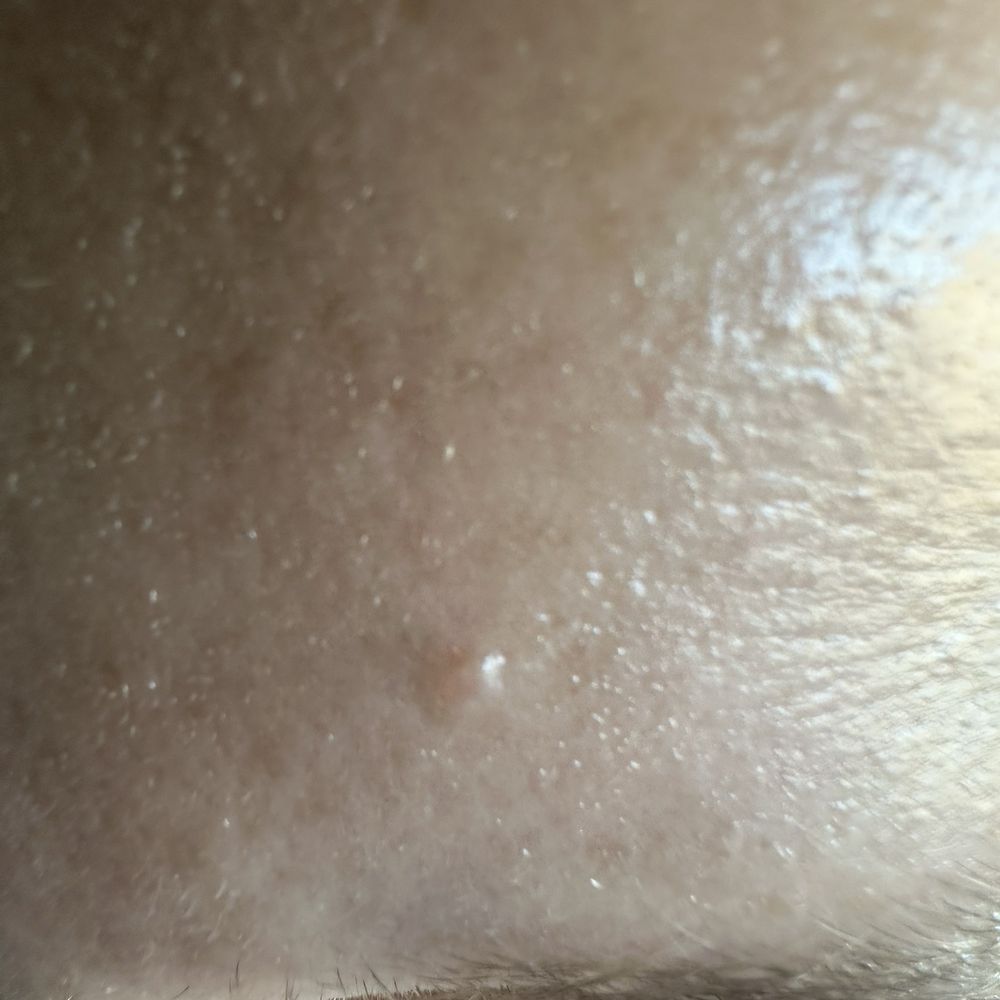 K Beauty Lab - Whiteheads remaining after treatment. - Skin Care Near Me - Ewa Beach, Hawaii
