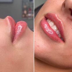 Injection Bar Medspa & Wellness - Natural lips filler
