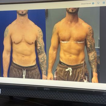 Cruise Plastic Surgery - Before and after on day 1! - Medical Spas Near Me - Newport Beach, California Cruise Plastic Surgery - Before and after on day 1! - Medical Spas Near Me - Newport Beach, California