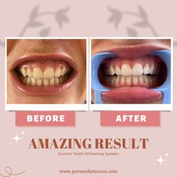 Laser Teeth Whitening