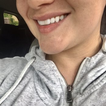 360 Dental Services - Side view after braces - General Dentistry Near Me - Tustin, California