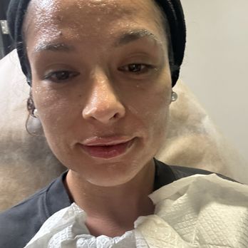 Sol And Skin - Numbing me up and lips are done - Medical Spas Near Me - San Diego, California Sol And Skin - Numbing me up and lips are done - Medical Spas Near Me - San Diego, California