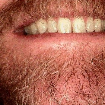 Schmidt Digital Dentistry - Before Zoom In Office Whitening - Cosmetic Dentists Near Me - Waukesha, Wisconsin