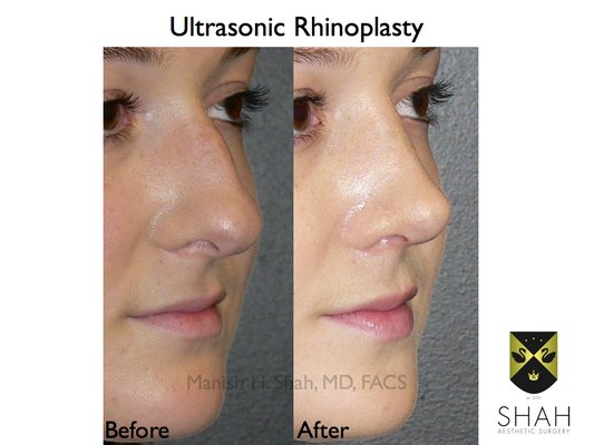 Shah Aesthetic Surgery - Rhinoplasty and Facelift Specialist by null