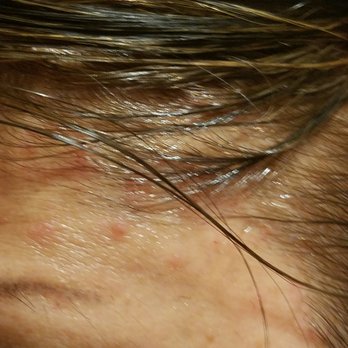 Salon Image TM - burned all the way to forehead - Hair Salons Near Me - Carson, California Salon Image TM - burned all the way to forehead - Hair Salons Near Me - Carson, California