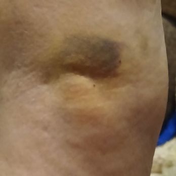 Quest Diagnostics - Photo of my arm a week after blood draw. - Laboratory Testing Near Me - Springfield, Oregon
