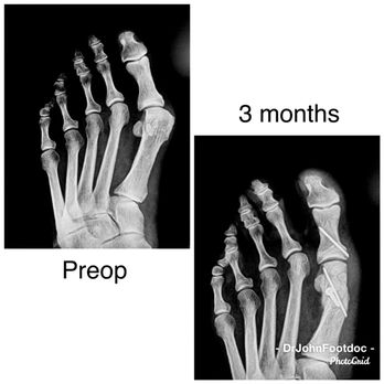 Ankle & Foot Centers - Bunion surgery correction before and after - Podiatrists Near Me - Marietta, Georgia Ankle & Foot Centers - Bunion surgery correction before and after - Podiatrists Near Me - Marietta, Georgia