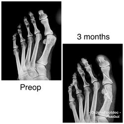 Ankle & Foot Centers - Bunion surgery correction before and after