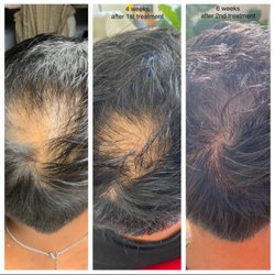 Active Lifestyle Aesthetics - Microneedling for hair growth progress picture!