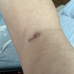 Octapharma Plasma - Right arm, it's actually been worse than this before!!!!