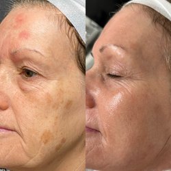 Magnolia Medical Aesthetics - Before & After custom skincare regimen including 3 months of at home skincare, 2 Diamond Glow facials and 1 Microneedling with PRP