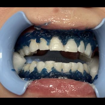 PhotoWhite - After two sessions - Teeth Whitening Near Me - Frisco, Texas PhotoWhite - After two sessions - Teeth Whitening Near Me - Frisco, Texas