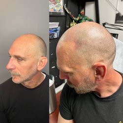 Roger Does SMP - Side profile of my client before and after