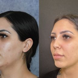 Chin Lipo Results Chin Lipo Results