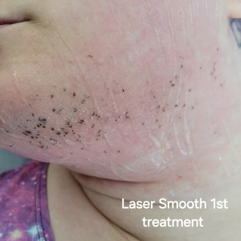 Laser Smooth - Laser Hair Removal Near Me - Gresham, Oregon Laser Smooth - Laser Hair Removal Near Me - Gresham, Oregon