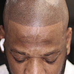 Scalp micro pigmentation by meechi - Scalp micro pigmentation