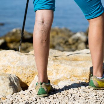 Physicians Vein Clinics 22 Photos Vascular Medicine 550 W Burnsville Pkwy Burnsville Mn Phone Number