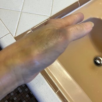 Metro Market - Photos of my broken wrist - Grocery Near Me - Brookfield, Wisconsin