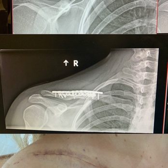 Select Physical Therapy - Costa Mesa - Before and After shots of my right clavicle - Physical Therapy Near Me - Costa Mesa, California