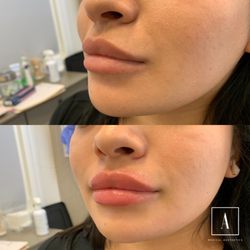 Ajliss Medical Aesthetics - Brea - Lip filler