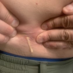 Tulsa Men's Clinic - Draining the incestion