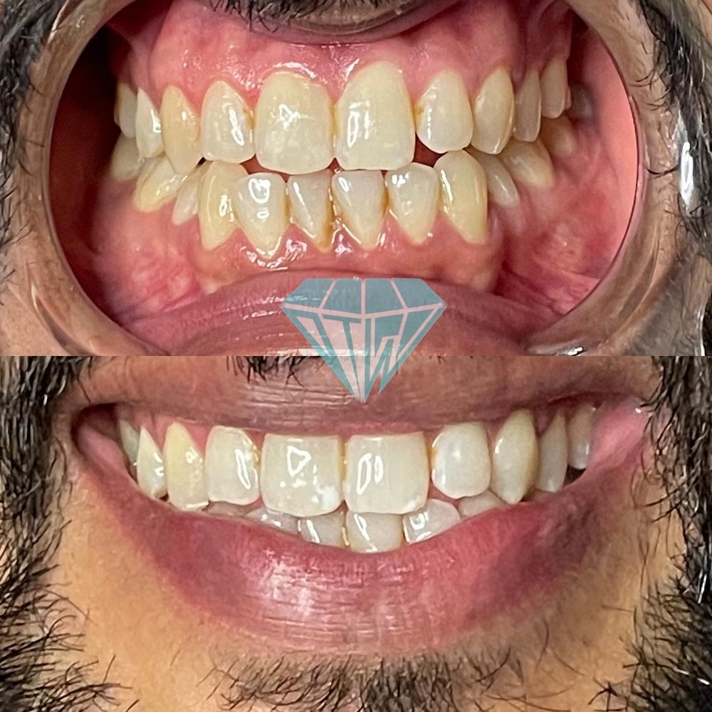 DIAMOND TEETH WHITENING nearby at 2300 Veterans Memorial Hwy SW