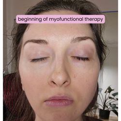 Oral Posture Orofacial Myofunctional Therapy - The beginning of my myofunctional therapy journey. My left side was really underdeveloped and asymmetries present.