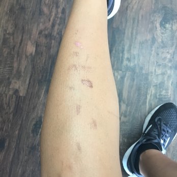 Shave No More - I week after treatment. - Laser Hair Removal Near Me - St Louis, Missouri Shave No More - I week after treatment. - Laser Hair Removal Near Me - St Louis, Missouri