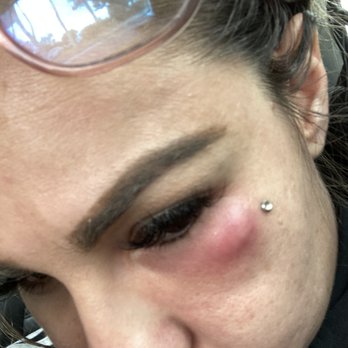 Moon Lash in Brea - This is a reaction from the eyelashes clearly you can tell very painful - Eyelash Service Near Me - Brea, California Moon Lash in Brea - This is a reaction from the eyelashes clearly you can tell very painful - Eyelash Service Near Me - Brea, California