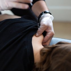 Ascent Health & Sport Therapy - Acupuncture, IMS, dry needling