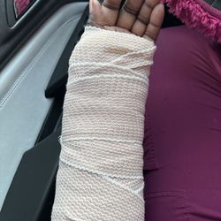 Jacksonville Orthopaedic Institute - Beaches - Bulky ill fitting temporary cast provided by urgent care..