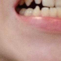 CaliDental - Sorry for the blurry photos. They were from two days ago when my filling came out and I got it refilled yesterday.