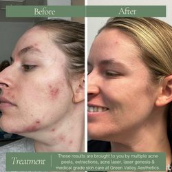 Green Valley Aesthetics - 9 month results from Green Valley Aesthetics. Medical grade at home skin care with a healthy lifestyle change can make a big impact at GVA!
