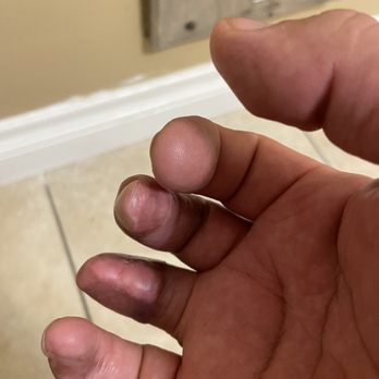 Selective Rehab - Able to now move my fingers - Physical Therapy Near Me - Newport Beach, California Selective Rehab - Able to now move my fingers - Physical Therapy Near Me - Newport Beach, California