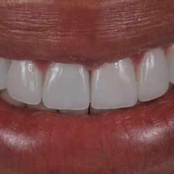 Huntington Beach Prosthodontics - Cosmetic dentistry | Natural looking veneers.