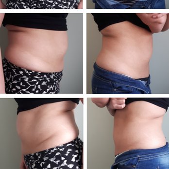 Curves & Contours - Client received Fat Freezing treatment on stomach and love handle area. Results shown are after one month. - Medical Spas Near Me - Waterloo, Ontario