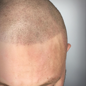 Hoi Tattoo - SMP (Scalp Micropigmentation) after - Permanent Makeup Near Me - Calgary, Alberta Hoi Tattoo - SMP (Scalp Micropigmentation) after - Permanent Makeup Near Me - Calgary, Alberta