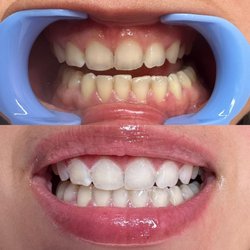 SmileyTeethSD