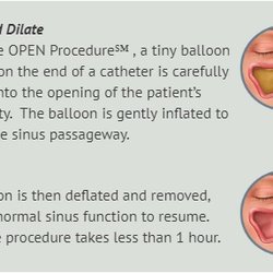 Franklyn R Gergits, MBA, DO, FAOCO - This is an example of our OPEN Procedure which works miracles for chronic sinus problems!