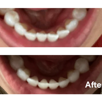 Center for Beautiful Smiles - Before / 8 Week Progress - General Dentistry Near Me - Chula Vista, California Center for Beautiful Smiles - Before / 8 Week Progress - General Dentistry Near Me - Chula Vista, California