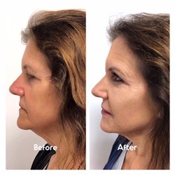 Bella Tu Med Spa Goshen - What an incredible transformation with filler!