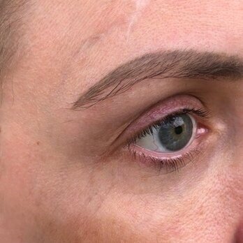 Glow Medical Aesthetics - After - Skin Care Near Me - Houston, Texas Glow Medical Aesthetics - After - Skin Care Near Me - Houston, Texas