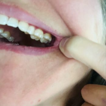 Glenwood Dentistry - Can't even tell which 2 top teeth they put the inlays on! - Cosmetic Dentists Near Me - Atlanta, Georgia Glenwood Dentistry - Can't even tell which 2 top teeth they put the inlays on! - Cosmetic Dentists Near Me - Atlanta, Georgia
