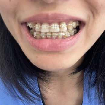 Oviedo Orthodontics - Roughly half way through my treatment. - Orthodontists Near Me - San Francisco, California Oviedo Orthodontics - Roughly half way through my treatment. - Orthodontists Near Me - San Francisco, California