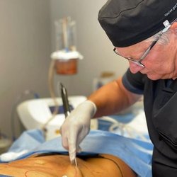 Precision Laser & Esthetics - Dr. Higginbotham performing a BeautiFill Liposuction procedure with fat-transfer.