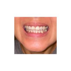 Devoted Dental - Can't wait for my Invisalign results.