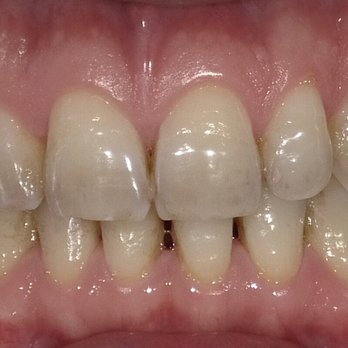 Forever Smile - Before - General Dentistry Near Me - Los Angeles, California Forever Smile - Before - General Dentistry Near Me - Los Angeles, California